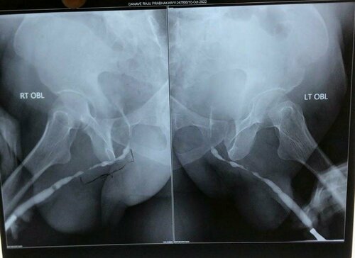 long segment Bullbar urethral stricture treated by BMG Urethroplasty | Dr. Bhoopat Bhati|Urozoone Holistic Kidney Care Clinic|Viman Nagar,Pune