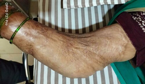 Burn Contracture Correction Surgery in Pune | Dr. Sandeep Naphade|Pushp Superspeciality Clinic|Pimple Saudagar,Pune