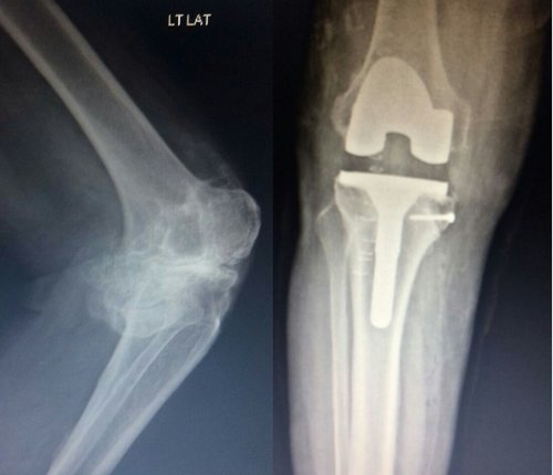 Pre and Post operation X-rays|Dr. Saraf's Joints Clinic|Karve Road ,Pune