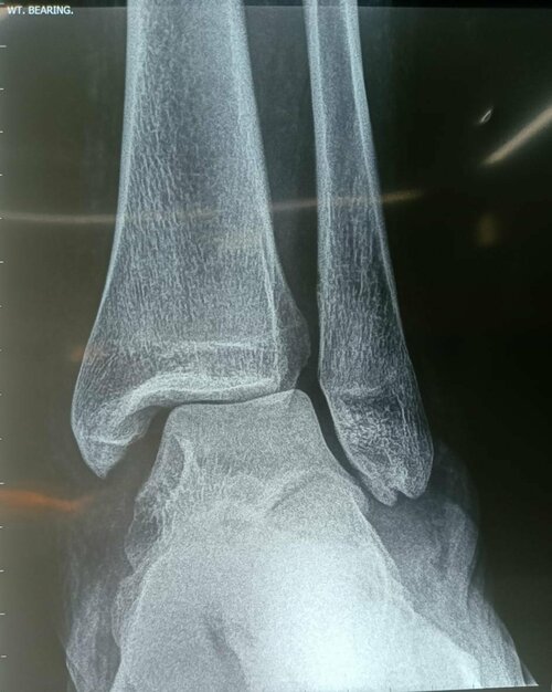 Foot Ball Injury Treated by Complex Ankle Ligament - Syndesmosis | Dr. Girish Motwani|Suyog Hospital|Suyog Nagar,Nagpur