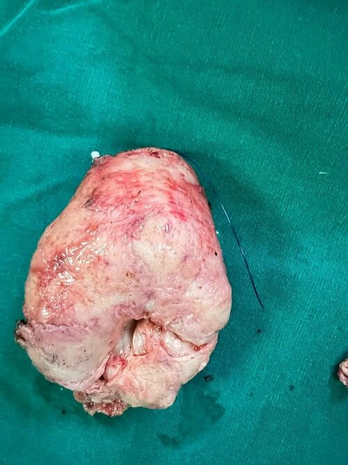 Robotic Prostatectomy in Pune | Dr. Bhoopat Bhati | Urologist|Urozoone Holistic Kidney Care Clinic|Viman Nagar,Pune