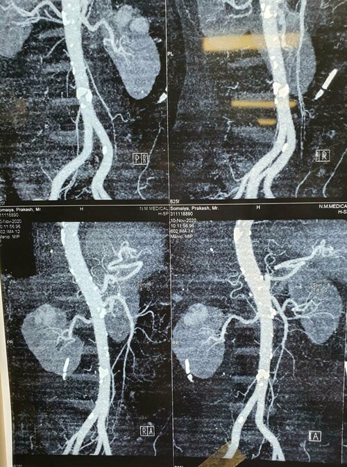 Abdomen Pain Caused due to Renal Mass Treated by Partial Nephrectomy | Dr. Bhoopat Bhati|Urozoone Holistic Kidney Care Clinic|Viman Nagar,Pune
