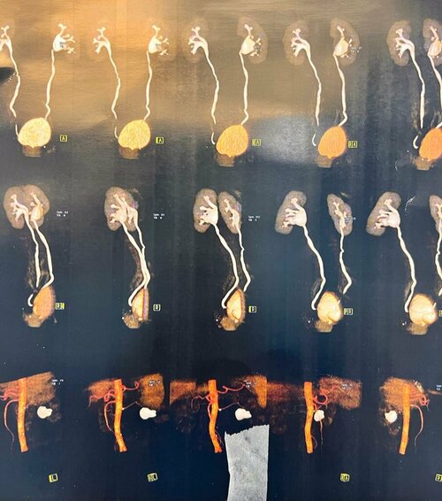 Pain in abdomen Post Angioplasty with Diabetes and Hypertension Treated by Dr. Bhoopat Bhati|Urozoone Holistic Kidney Care Clinic|Viman Nagar,Pune