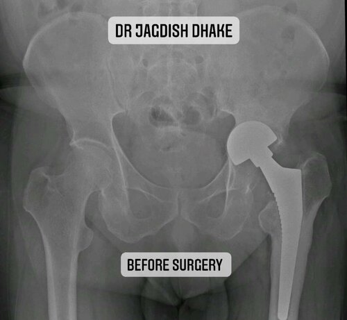 Bipolar Head Removal, Bone Grafting and Acetabular Cage Fixation, conversion to Total Hip replacement by Dr. Jagdish Dhake|Asperia Clinic & Rahee Hospital|Bibvewadi,Pune