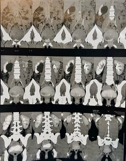 Abdomen Pain caused by PUJ Obstruction by Laparoscopic Pyeloplasty | Dr. Bhoopat Bhati|Urozoone Holistic Kidney Care Clinic|Viman Nagar,Pune