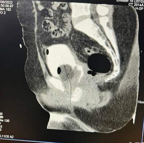 Difficulty in Urinating Treatment by VVF repair | Dr. Bhoopat Bhati|Urozoone Holistic Kidney Care Clinic|Viman Nagar,Pune