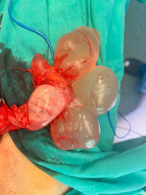 Scrotal Exploration with Bilateral Cystic Mass Lesion Excision | Dr. Bhoopat Bhati|Urozoone Holistic Kidney Care Clinic|Viman Nagar,Pune