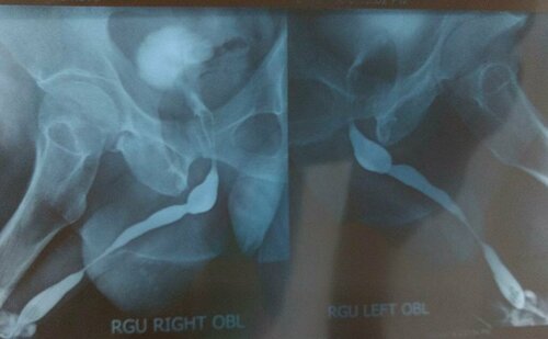 Difficulty in Urinating Treatment by Buccal Mucosa Graft Urethroplasty | Dr. Bhoopat Bhati|Urozoone Holistic Kidney Care Clinic|Viman Nagar,Pune