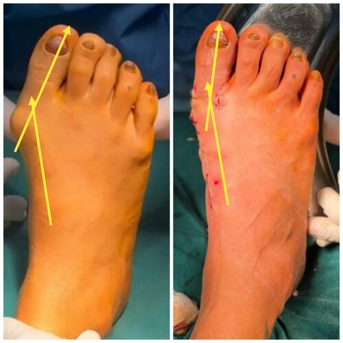 hallux valgus correction by Dr Girish|Suyog Hospital|Suyog Nagar,Nagpur