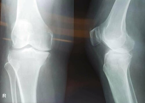 Treatment for Osteoarthritis by Dr. Jagdish Dhake | Knee replacement surgeon Pune|Asperia Clinic & Rahee Hospital|Bibvewadi,Pune