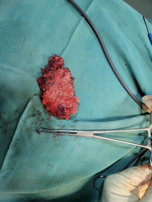 Mini Gastric Bypass For Morbid Obesity in Pune Dr. Sameer Badani|Health Havens|NIBM Road,Pune