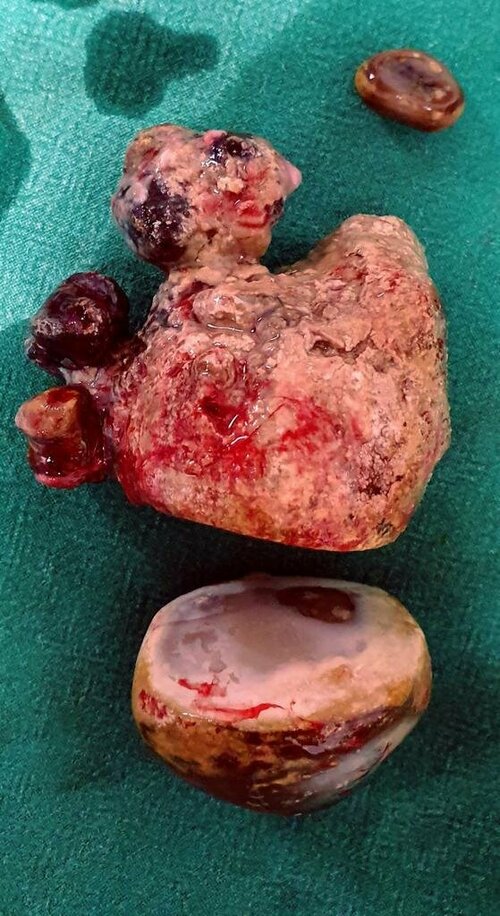 Large Kidney Stone Removed by Surgery in Pune | Dr. Bhoopat Bhati|Urozoone Holistic Kidney Care Clinic|Viman Nagar,Pune