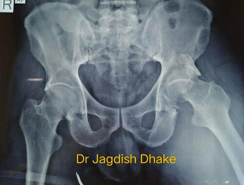 Pre Op - Reconstruction of posterior acetabular wall and fixation with Recon plate done by Dr. Jagdish Dhake|Asperia Clinic & Rahee Hospital|Bibvewadi,Pune