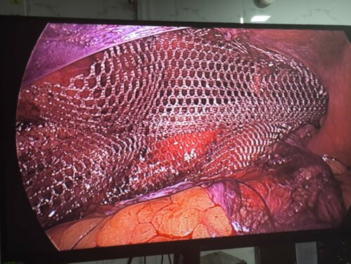 Advanced TAPP Technique for Left Inguinal Hernia Repair at Pulse Multispeciality Hospital|Pulse Multispeciality Hospital|Navale Bridge,Pune