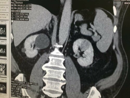 Abdomen Pain Caused by Left Renal mass Treated with Open Partial Nephron Sparing | Dr. Bhoopat Bhati|Urozoone Holistic Kidney Care Clinic|Viman Nagar,Pune