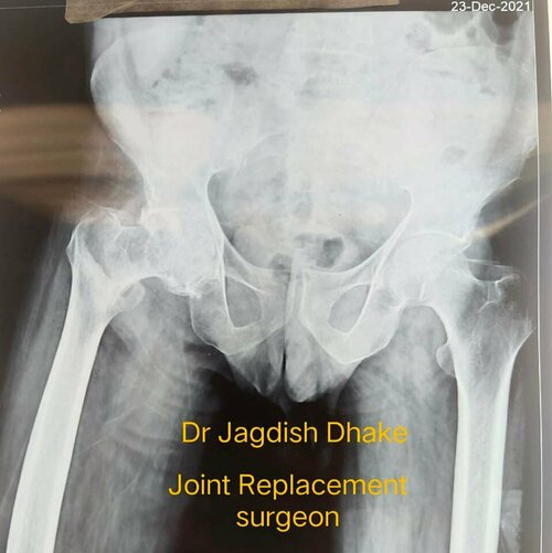 Hybrid total hip replacement | Dr. Jagdish Dhake|Asperia Clinic & Rahee Hospital|Bibvewadi,Pune