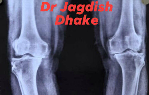 Total Knee Replacement - Dr. Jadish Dhake|Asperia Clinic & Rahee Hospital|Bibvewadi,Pune