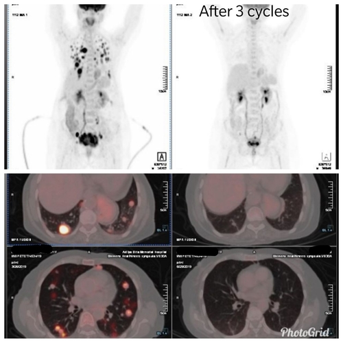 Chemotherapy in stage 4 cancers|OncoWin Clinic|Aundh,Pune