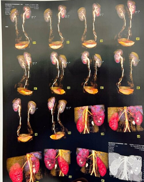 Abdomen Pain Caused By Renal Stones Treated By RIRS | Dr. Bhoopar Bhati|Urozoone Holistic Kidney Care Clinic|Viman Nagar,Pune