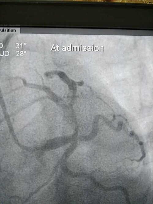 Blocked young heart and Doctor Yogesh|Jamage Heart Centre|Shivaji Road,Miraj