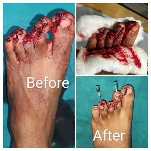 Successful Complex Plastic Surgeries at Matoshree Madanbai Dhariwal Hospital|Ruby Hall - Matoshree Madanbhai Dhariwal Hospital|Ghodnadi,Shirur