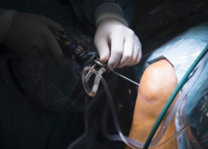 knee Arthroscopy