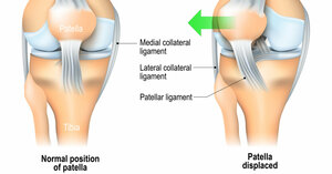 Patellar Dislocation