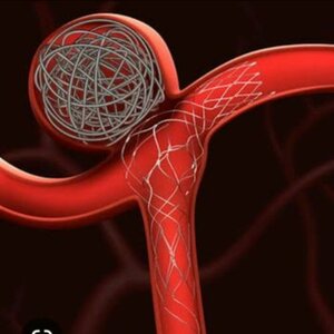 Brain Aneurysm Coiling