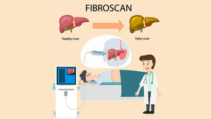 Fibroscan