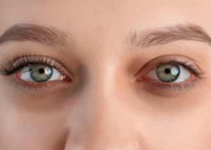 Under eye dark circle treatment