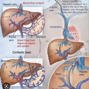 Transjugultar / Direct Instraheptic Porto-systemic Shunts ( TIPS - DIPS)