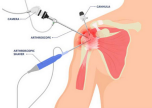 shoulder Arthroscopy