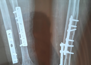 Complex and Neglected Orthopedic Cases