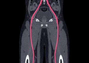 Peripheral Interventions