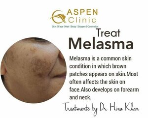 Melasma Treatment in Pune | Dr. Hina Khan