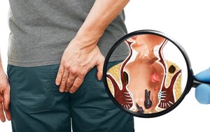 Hemorrhoids / Piles