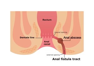 Anal Fistula