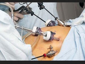 Laparoscopic Surgery