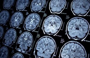 Best Neurologist in Kalyan Nagar