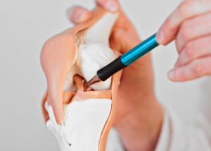 Ligament Reconstruction (ACL/PCL)