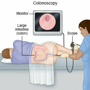 Colonoscopy