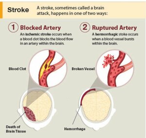 Stroke Management