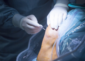 Arthroscopy