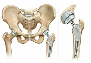 Hip Replacement/ Hip Arthroplasty