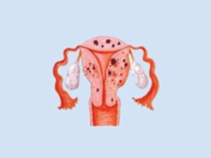 Adenomyosis