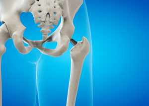 Hip Replacement
