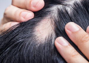 Pattern Baldness Male/Femal