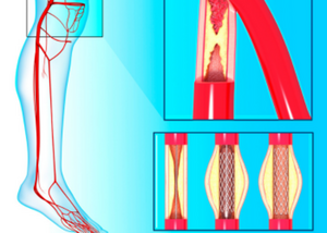 Angiography, Ballooning (Angioplasty) And Stenting