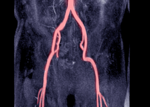 Aortic Aneurysms Surgery