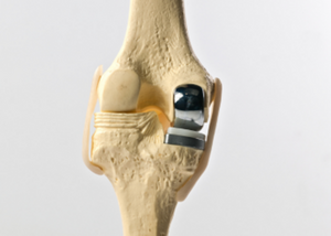 Unicompartmental / Total Knee Replacement